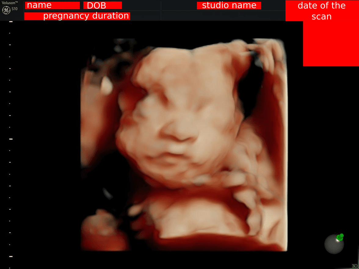 Example of an uncropped ultrasound scan showing personal information