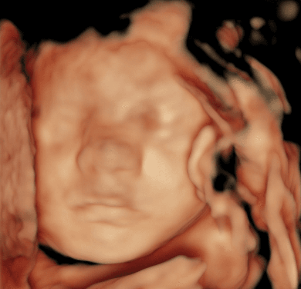 Customer's original 3D ultrasound scan