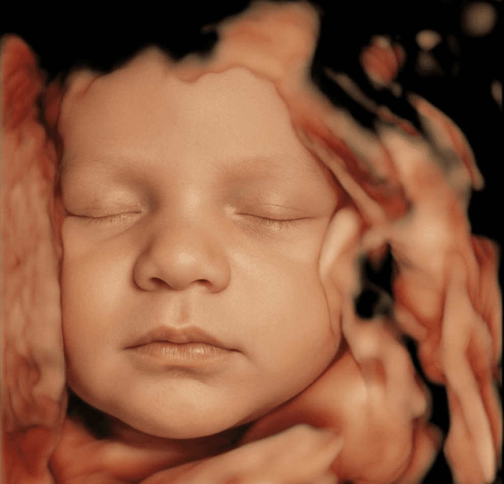 Photorealistic enhancement produced from the ultrasound