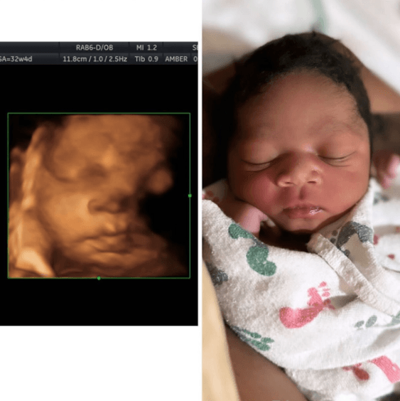 Amber-toned 3D ultrasound next to photo of the same baby after birth showing actual skin color