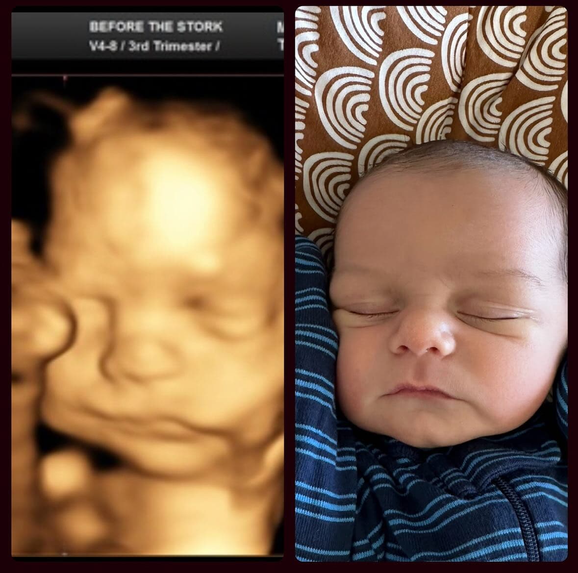 3D ultrasound side by side with born baby showing how the nose appears wider on the scan